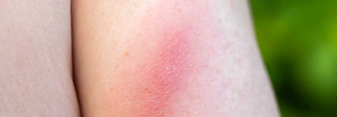 Geröteter Hautausschlag am Arm
